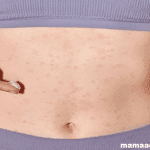 Rash On Your Stomach After a C-Section?