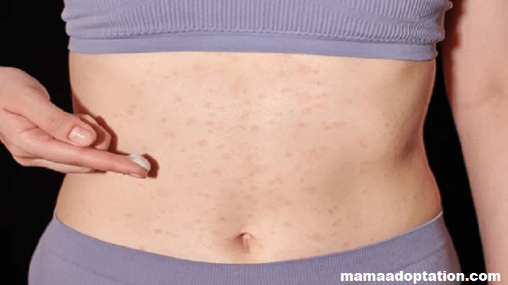 Rash On Your Stomach After a C-Section?