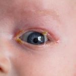 newborn eye keeps getting crusty