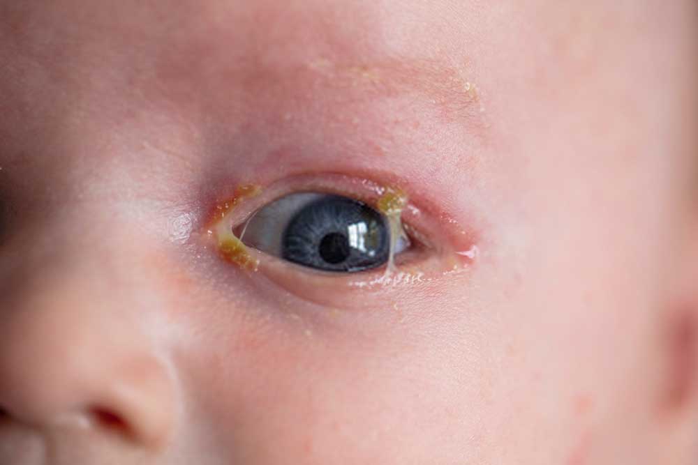 newborn eye keeps getting crusty