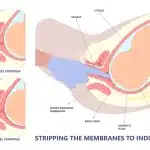 membrane Sweep