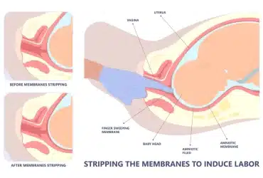 membrane Sweep